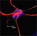 Astrocytoma