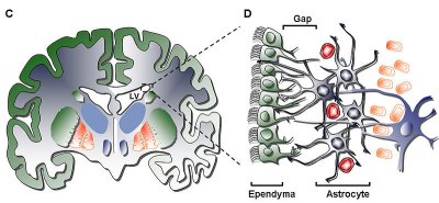 Ependymoma diagram